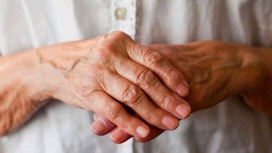 Reumatoidartriit põhjustab sõrmede liigeste valu ja turset. 