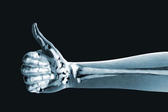 Röntgenikiirgus võib aidata diagnoosida valu sõrmede liigestes